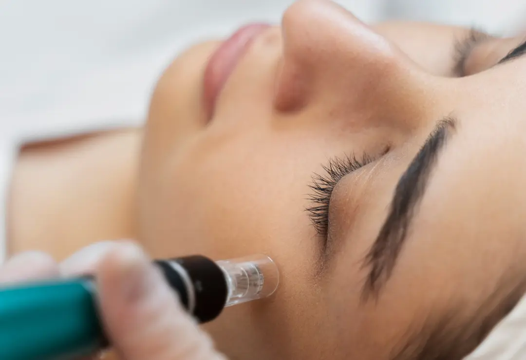 Microneedling