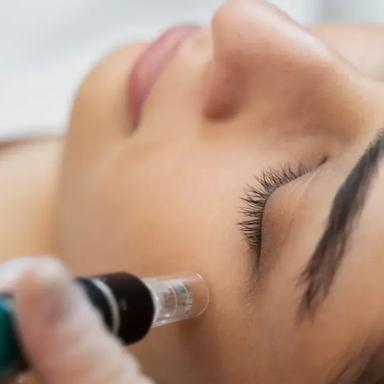 Microneedling